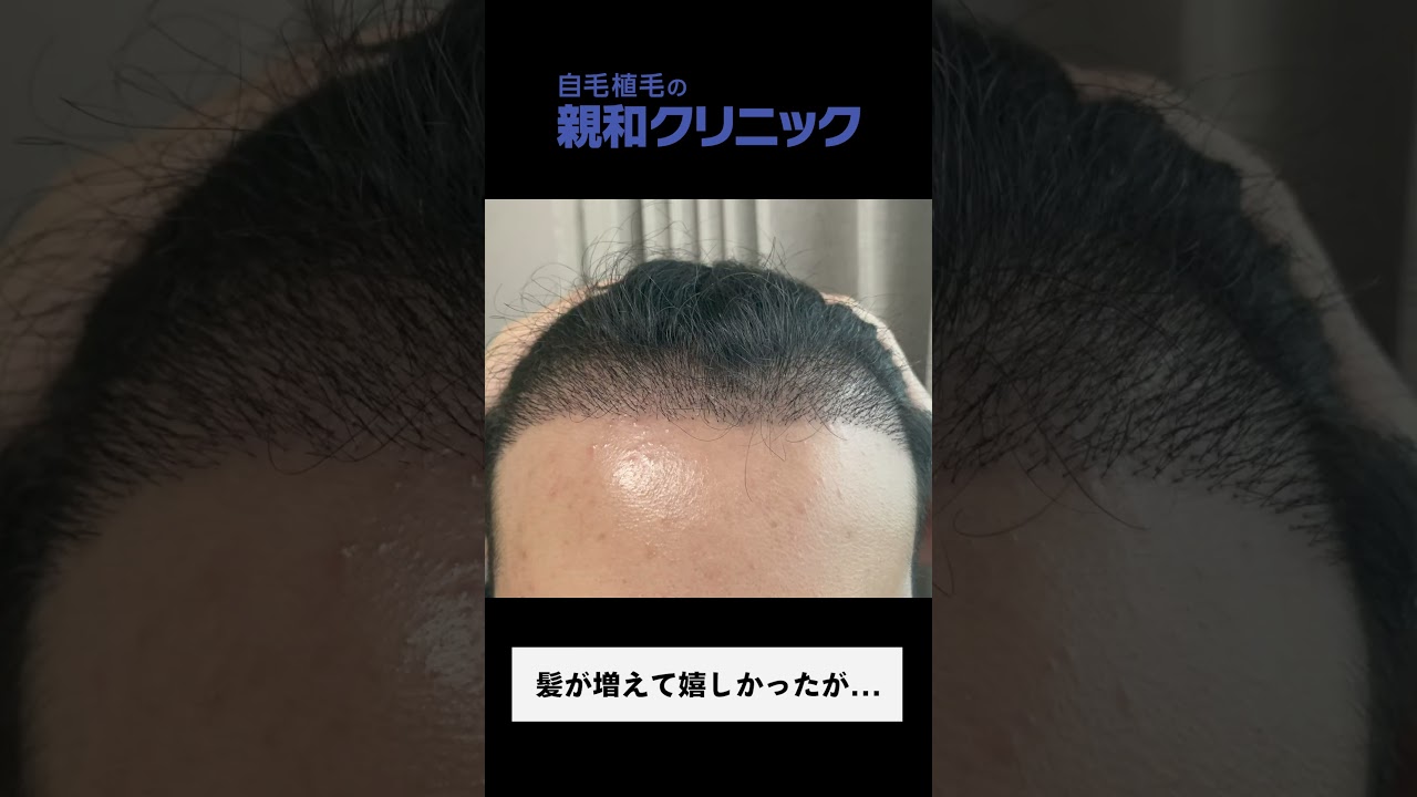 【自毛植毛】30代男性のM字の悩みが改善！！【AGA】【薄毛】#shorts