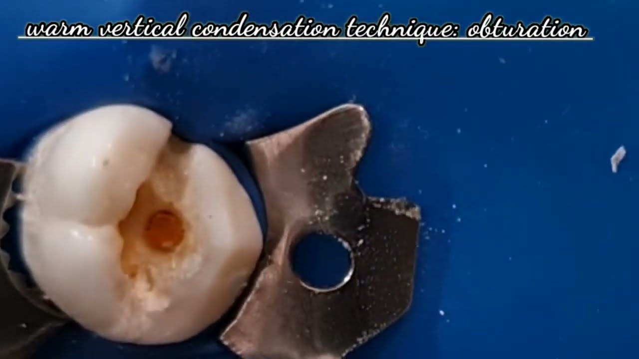 obturation using pen: warm vertical condensation technique