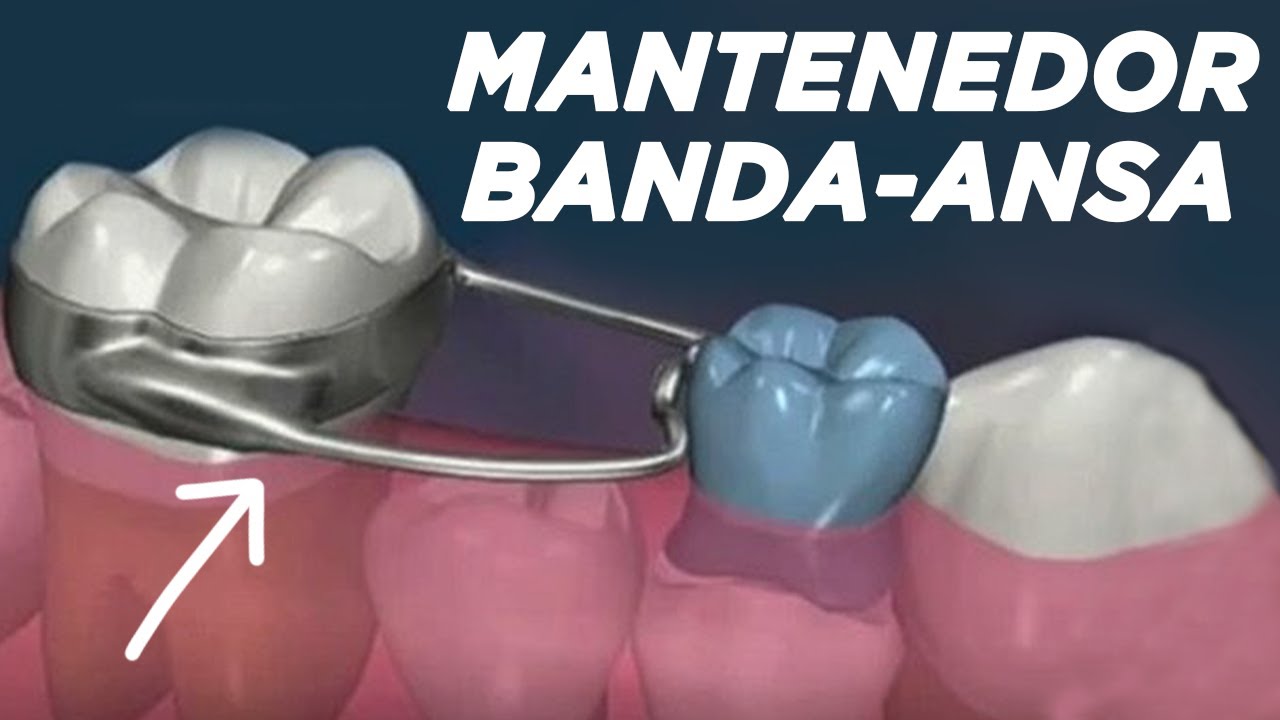 Mantenedor banda-ansa
