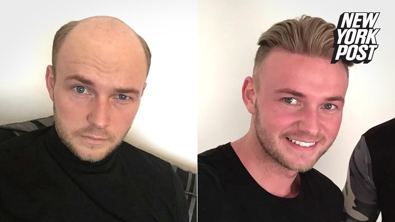 Bald Guys Are Wigging Out for These Believable Hairpieces from Quiff and Co. | New York Post