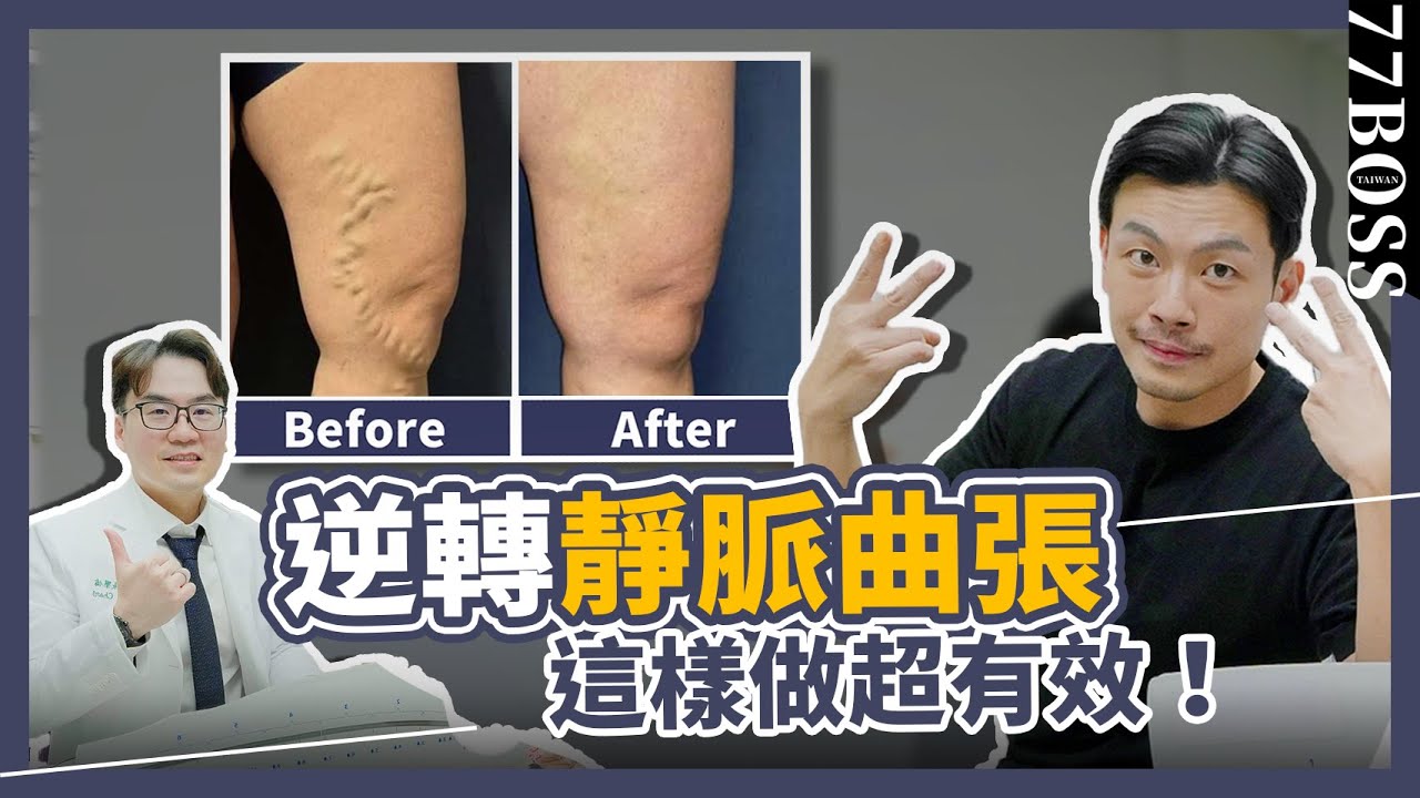 靜脈曲張不只醜，嚴重居然會致命！？權威名醫教你如何逆轉，這樣做，超有效！？feat.張學倫醫師【77老大】