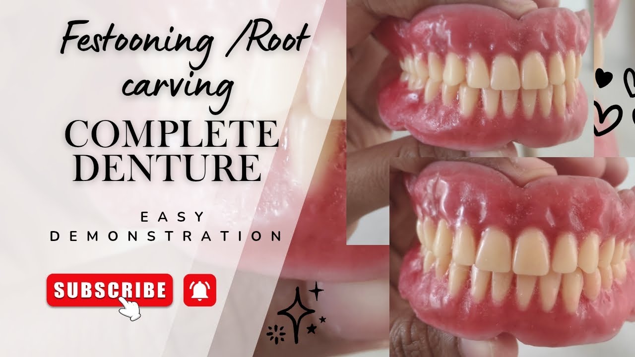 Festooning / Root Carving in Complete Dentures | Step-by-Step Demonstration
