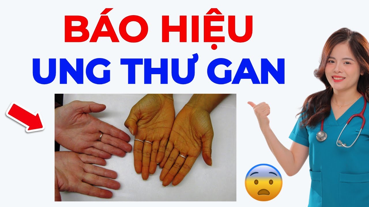 6 dấu hiệu UNG THƯ GAN phát hiện ngay tại nhà | Dr Thùy Dung