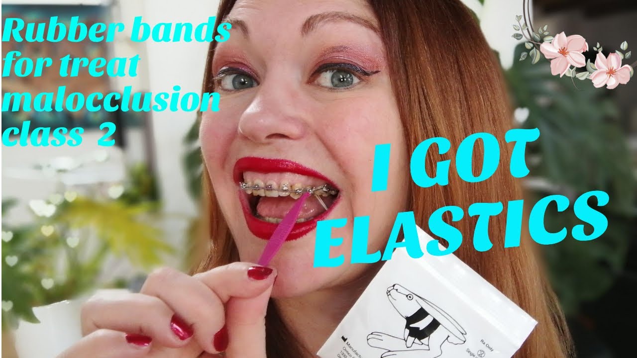 I GOT ELASTICS, rubber bands braces! Damon braces journey for overbite class 2. How to deal with?