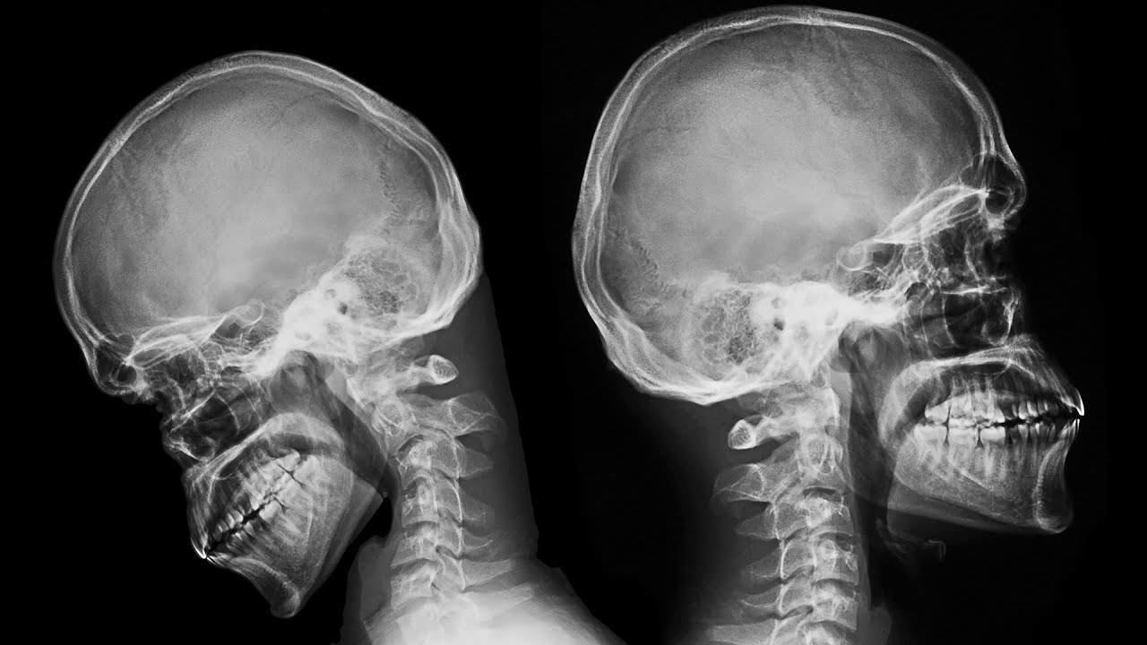 What Texting Does To Your Neck