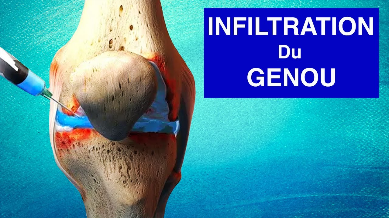 ARTHROSE DU GENOU :  Infiltration de Corticoïdes