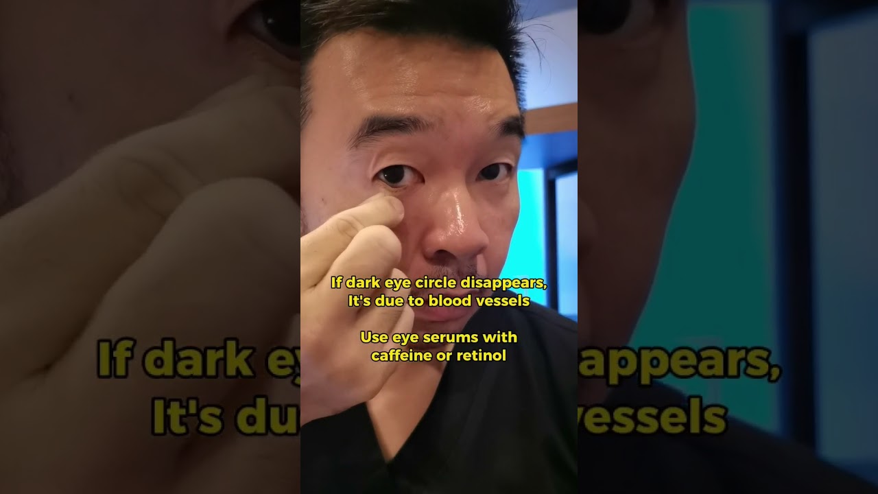 Suffering from dark eye 👀circles?