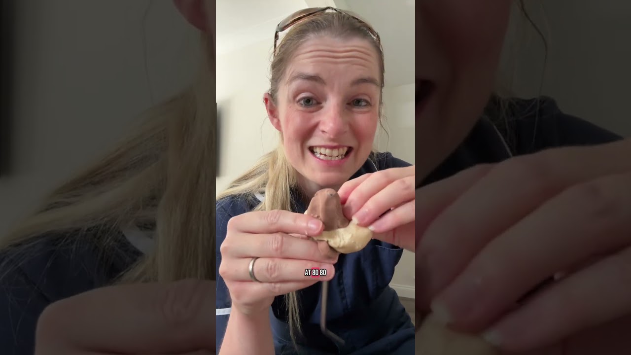 Part 2 balloon catheter induction #inducinglabour #inductionoflabour #pregnancy #pregnant #birth