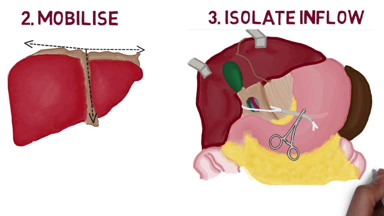 Liver Cancer by SurgEd