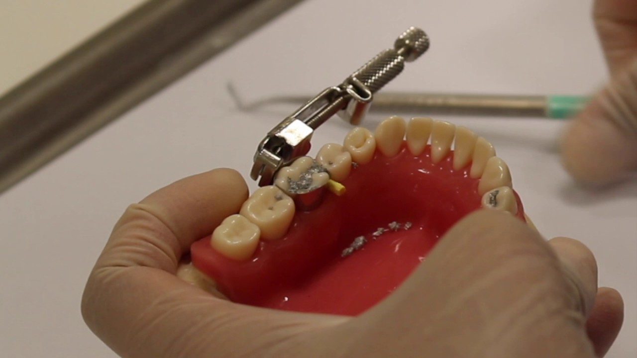 Class II amalgam cavity preparation & restoration