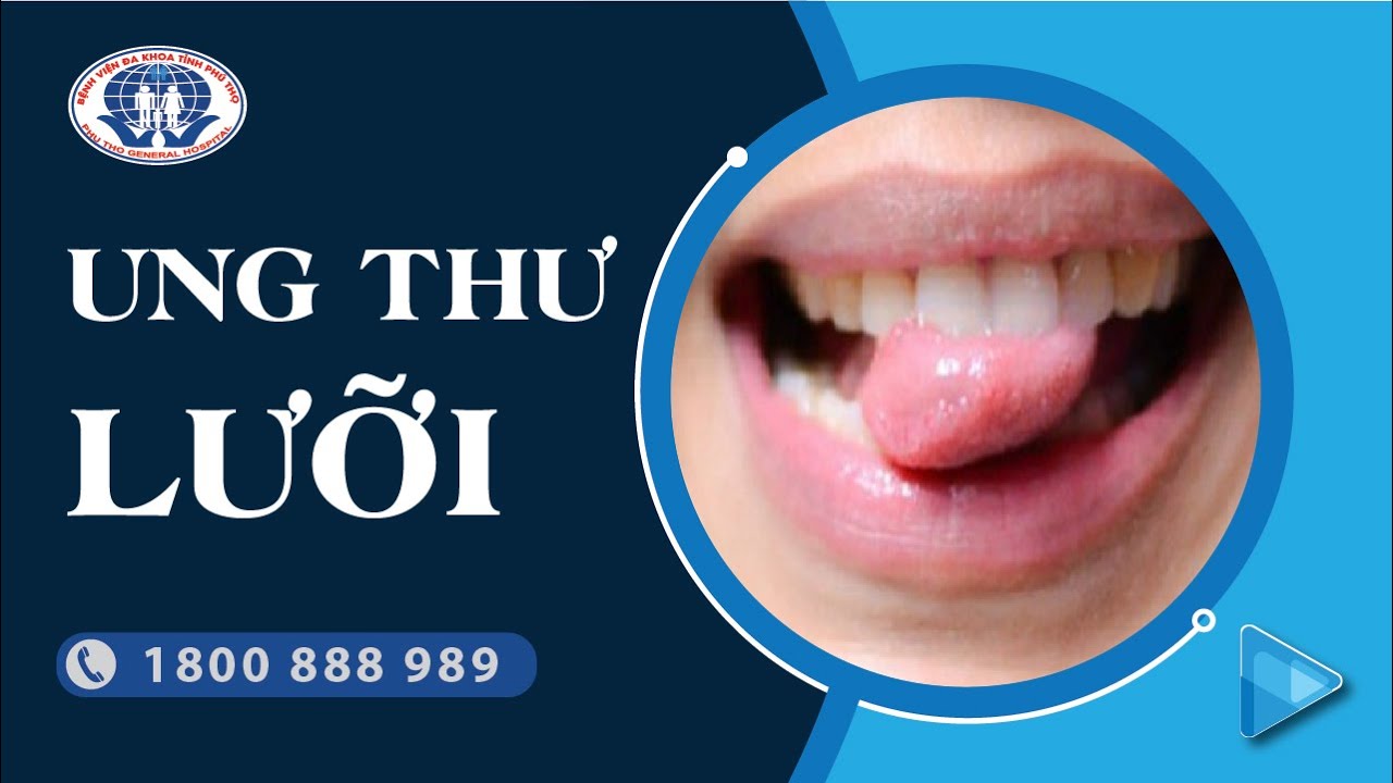Ung thư lưỡi