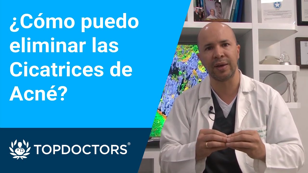 &iquest;C&oacute;mo puedo eliminar las Cicatrices de Acn&eacute;?