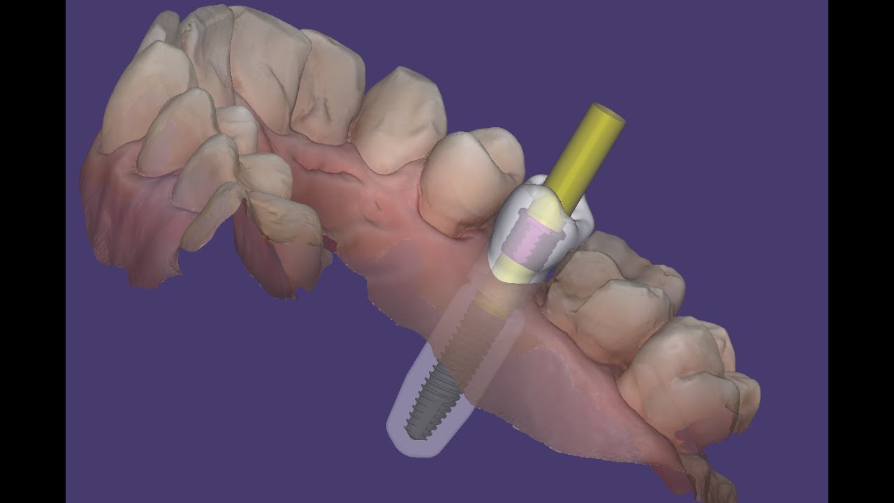 Cirugia guiada com provisório imediato (exoplan)