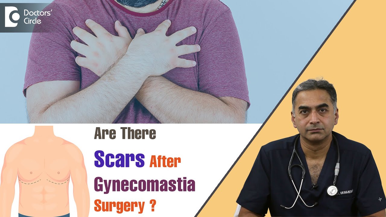 3 Types of Scars After Gynecomastia Surgery | Surgeon Conceals Scar-Dr. Srikanth V | Doctors' Circle