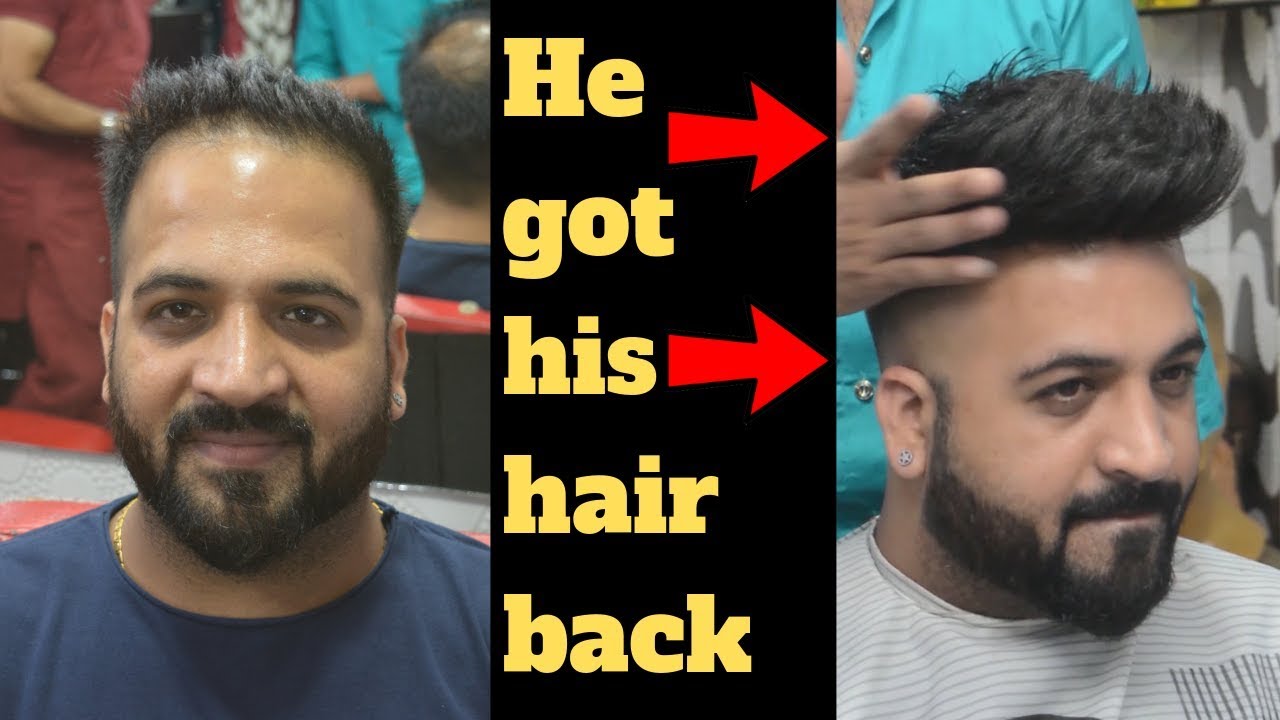 Non-surgical hair replacement in Delhi.Before & After Hair patch in Delhi.🔥