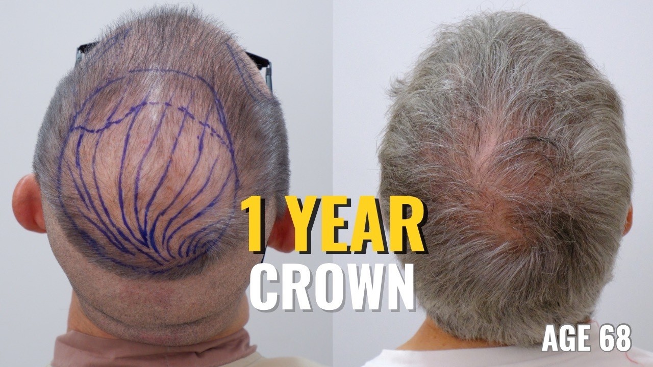 Hair Transplant Results After 1 Year (Age 68) | Crown Transplant in Bangkok