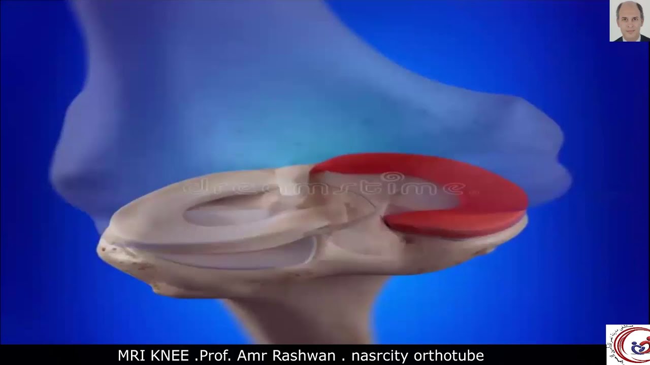 Knee MRI. Prof. Amr Rashwan. nasrcity covid19 time online lectures 2020