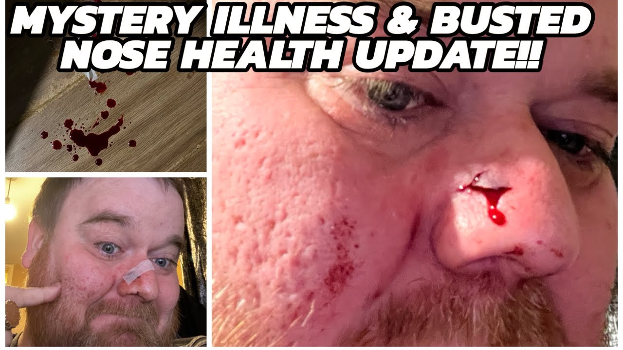 MYSTERY ILLNESS & BUSTED NOSE HEALTH UPDATE!!