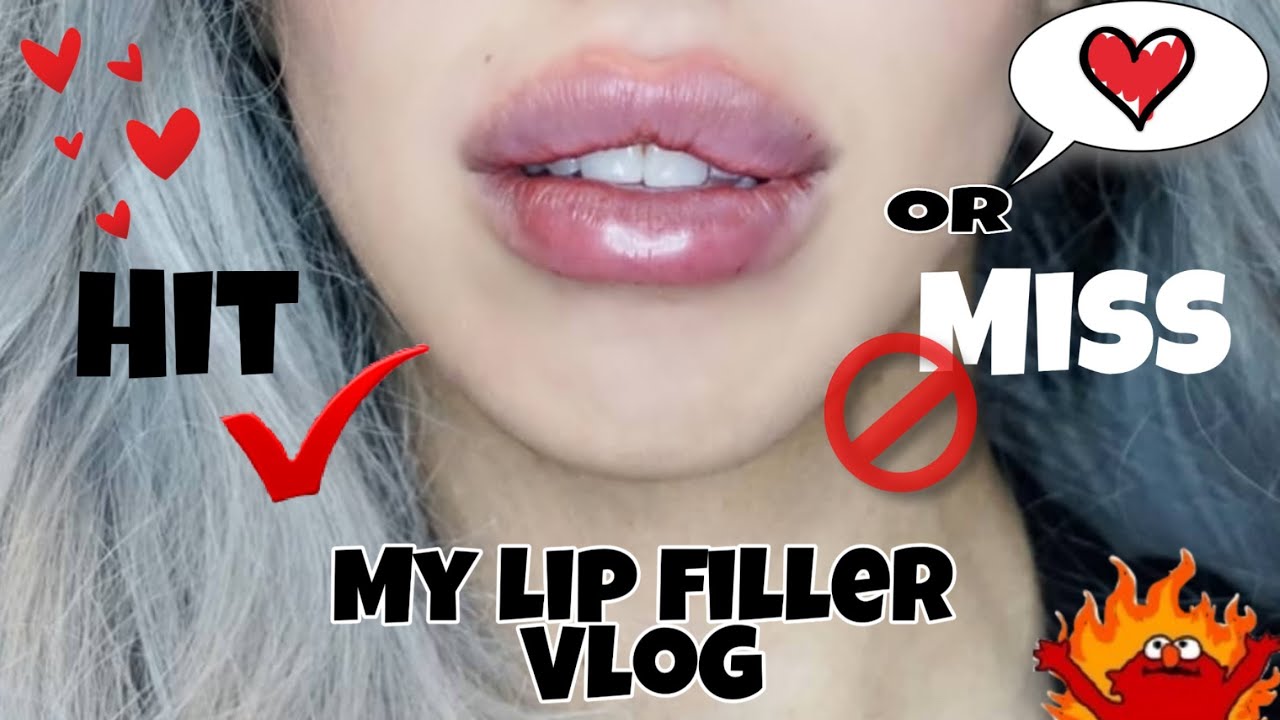 VLOG 1 - ALL ABOUT MY LIP FILLER EXPERIENCE WITH SY CLINIC AT HARLEY STREET LONDON.
