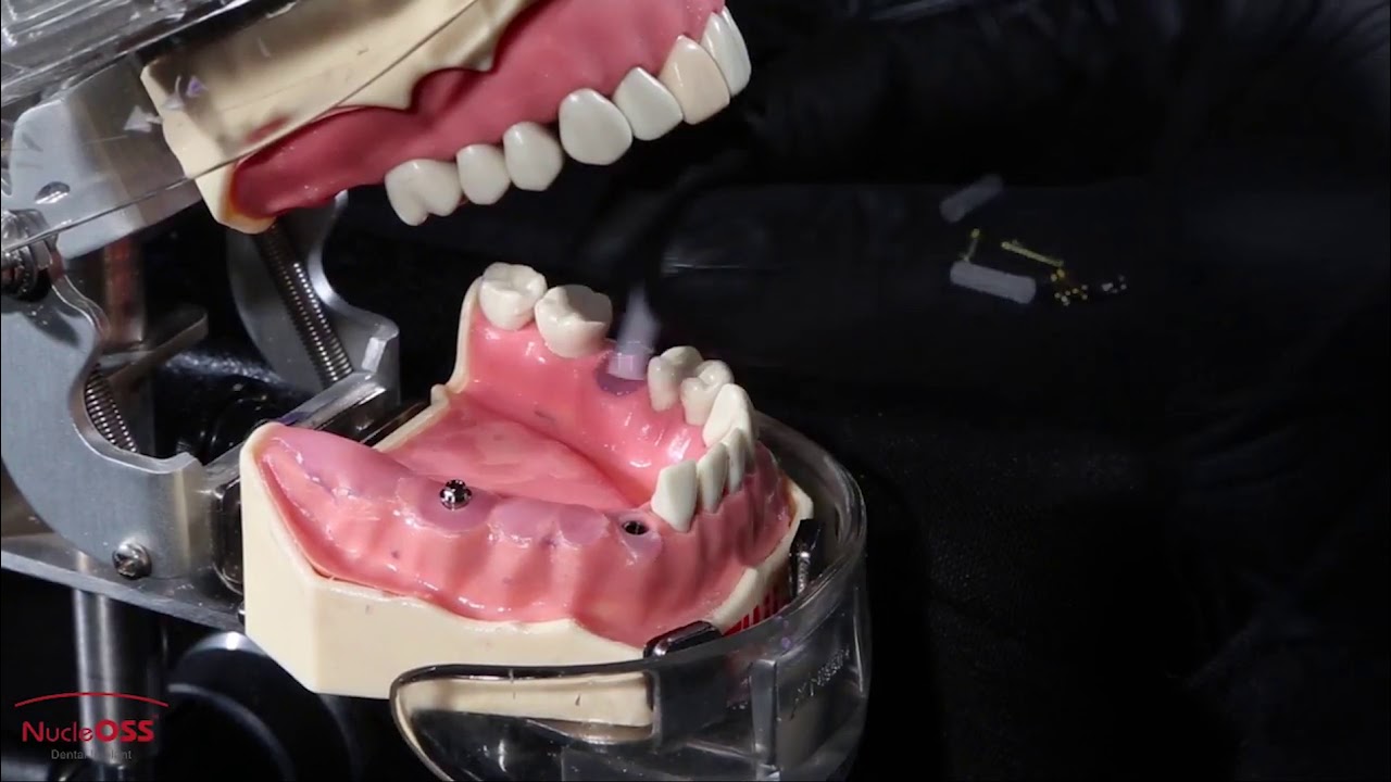 NucleOSS T6 Universal TiBase Casting Abutment   NoHex