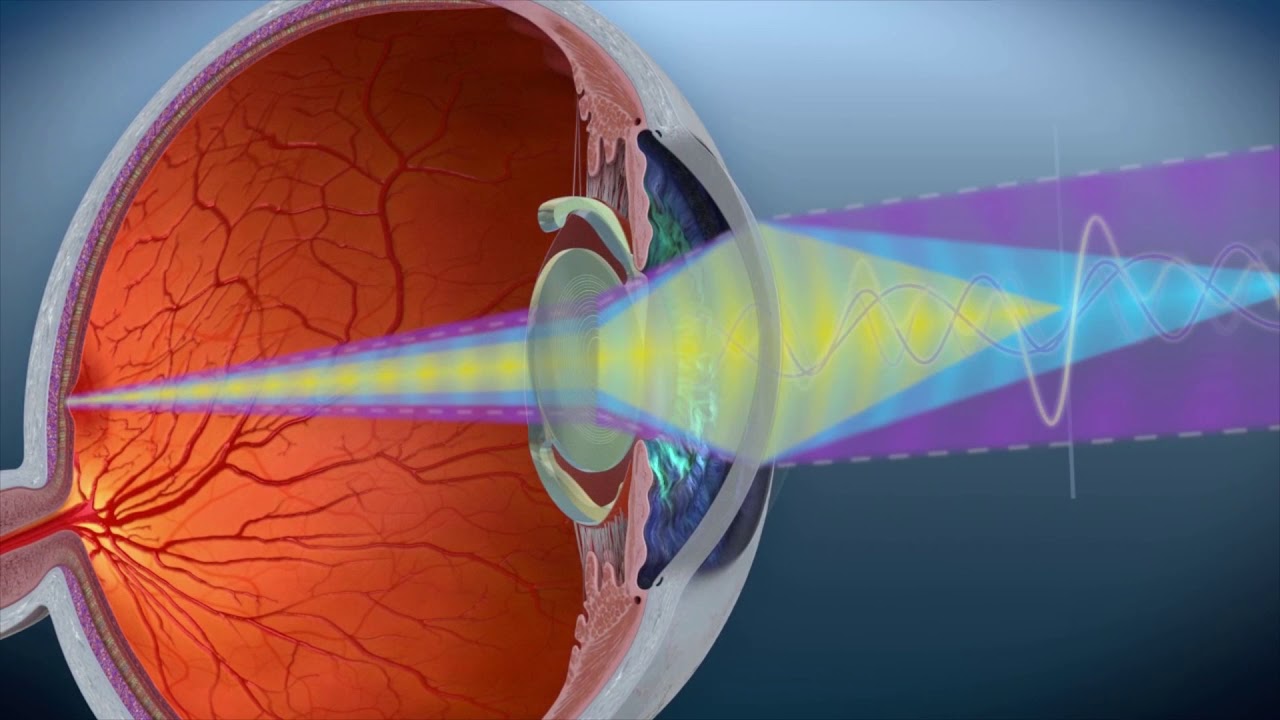 ИОЛ нового поколения AcrySof IQ PanOptix