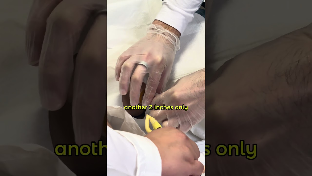 Improve patient care: Male catheter insertion taught by our expert. 📚 #ClinicalPractice #howto