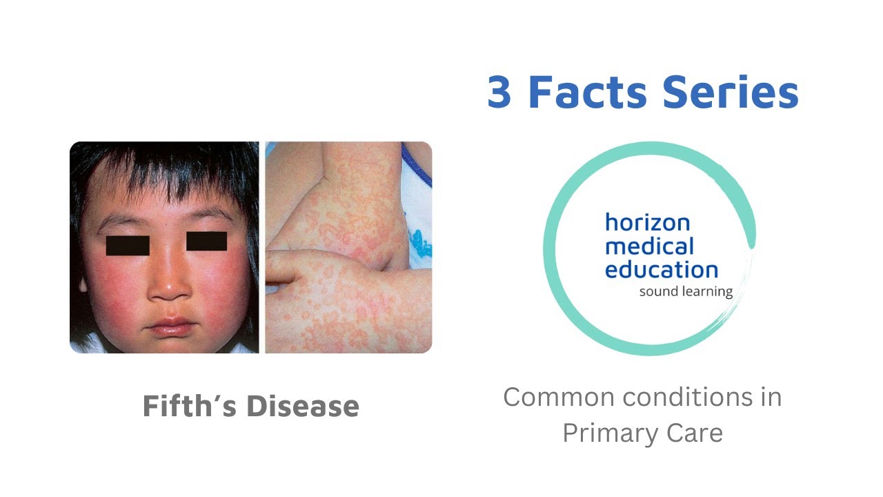 #Fifth Disease #Parvovirus B19 #slapped cheek syndrome (Erythema Infectiosum) #3facts