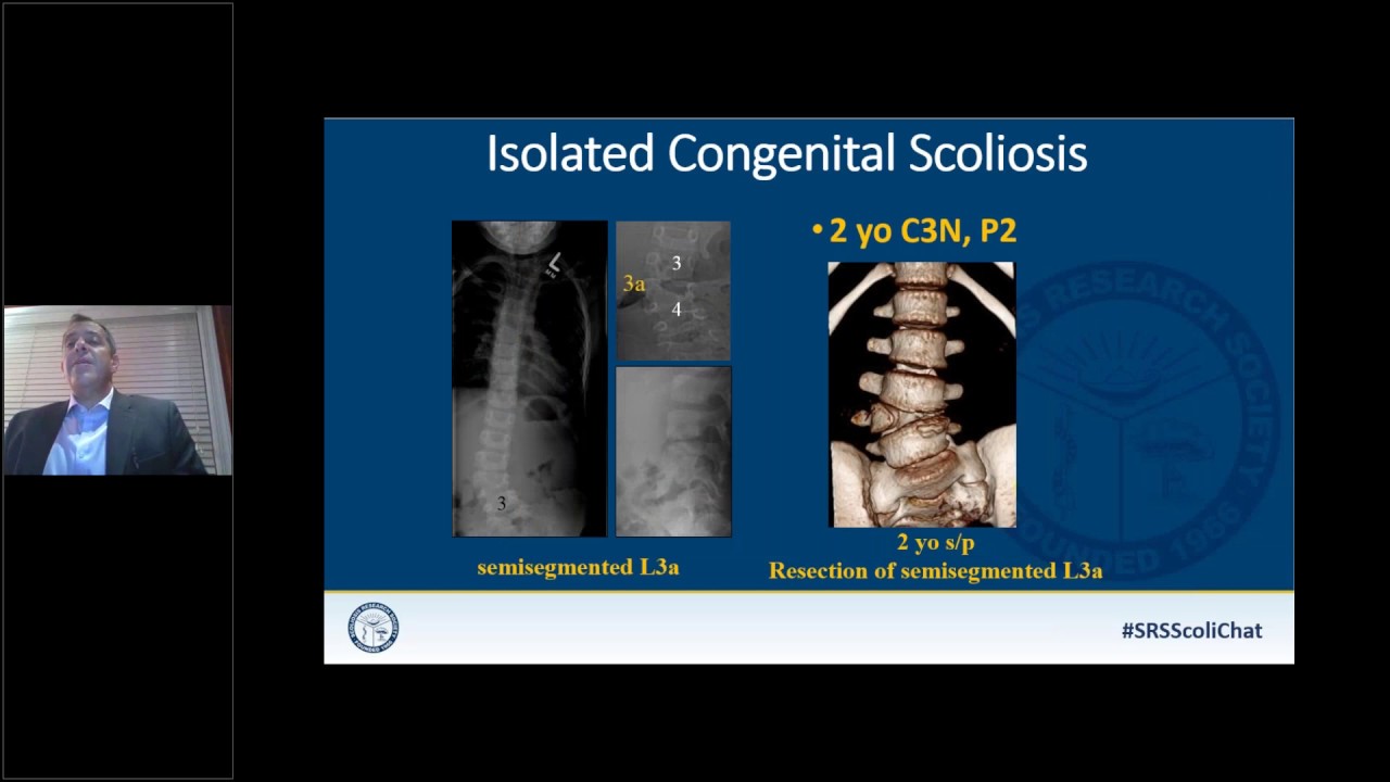 SRS Patient Webinar: Scoliosis in the Young Child