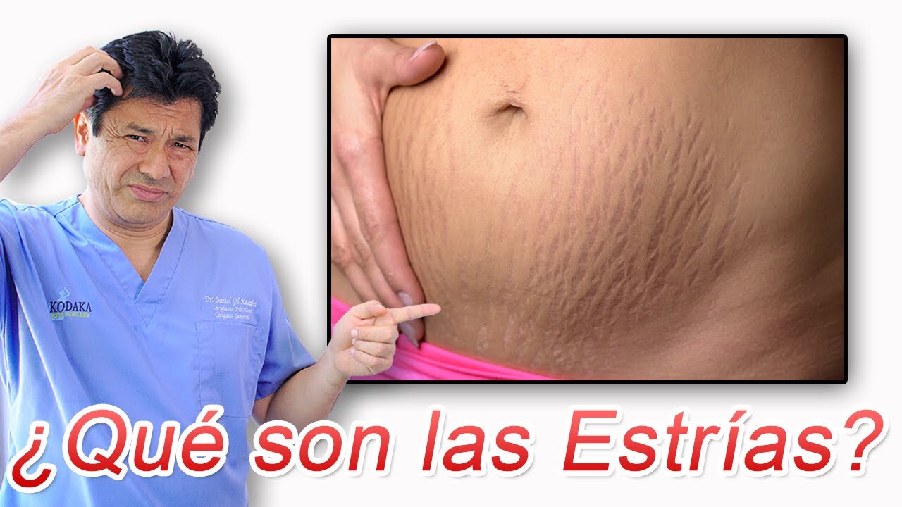 ¿Qué Son Las Estrías Y Qué Las Ocasionan?