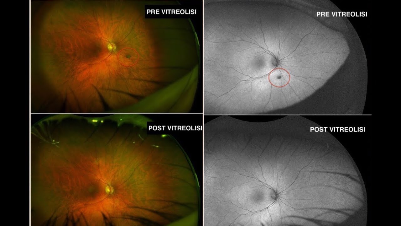 Vitreolisi con Yag Laser Ellex presso Sekal microchirurgia dott. Massimo Camellin