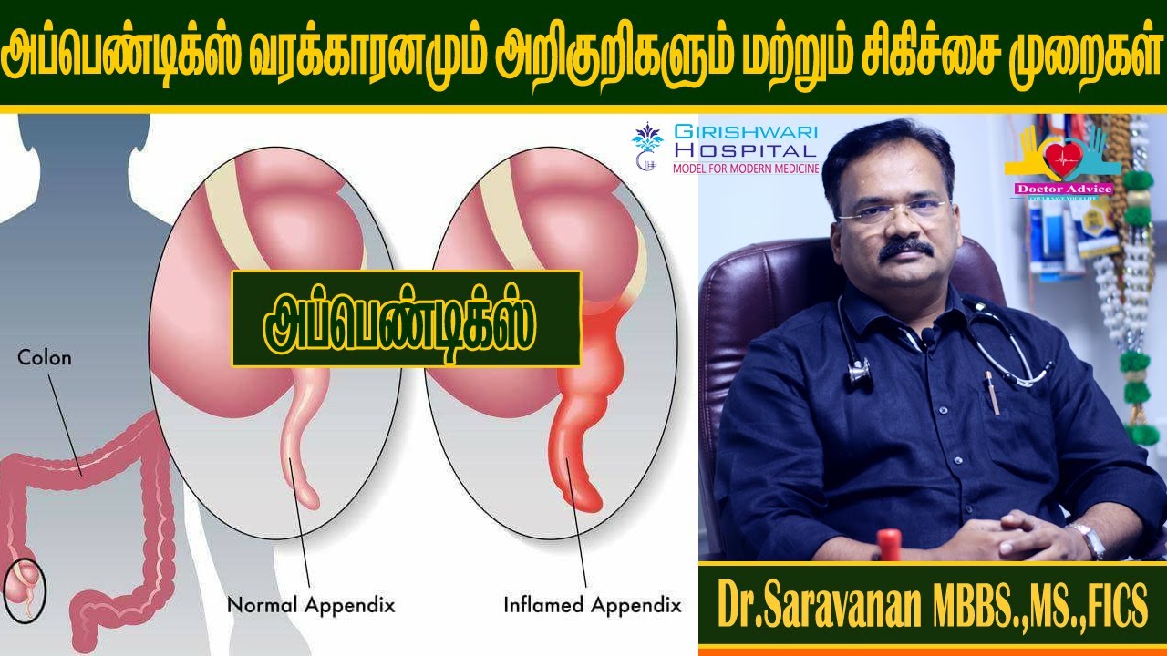 அப்பெண்டிக்ஸ் அறிகுறிகள் பற்றி தெரியுமா / Appendix symptoms in tamil /Doctor Advice