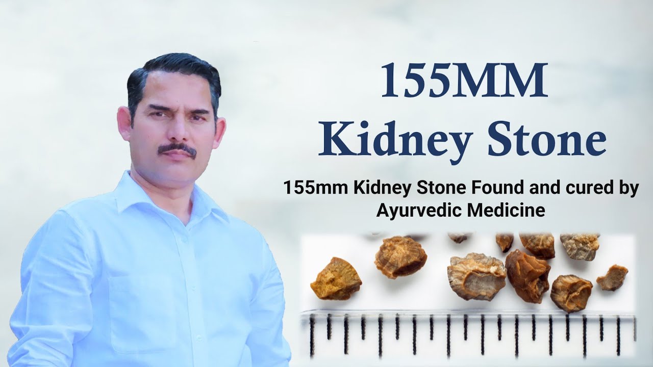 Karan Singh Vaidh Kidney Stone Rare Case Studies Reports views