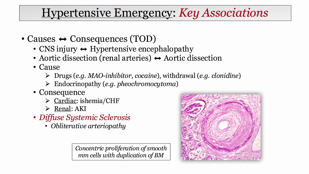 12DaysinMarch, Blood Pressure III, Malignant HTN for the USMLE Step One Exam