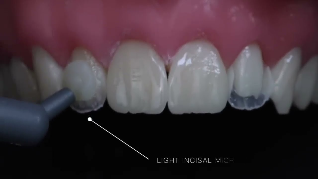 Peg Laterals Restorations with  Rhodri Thomas, BDS