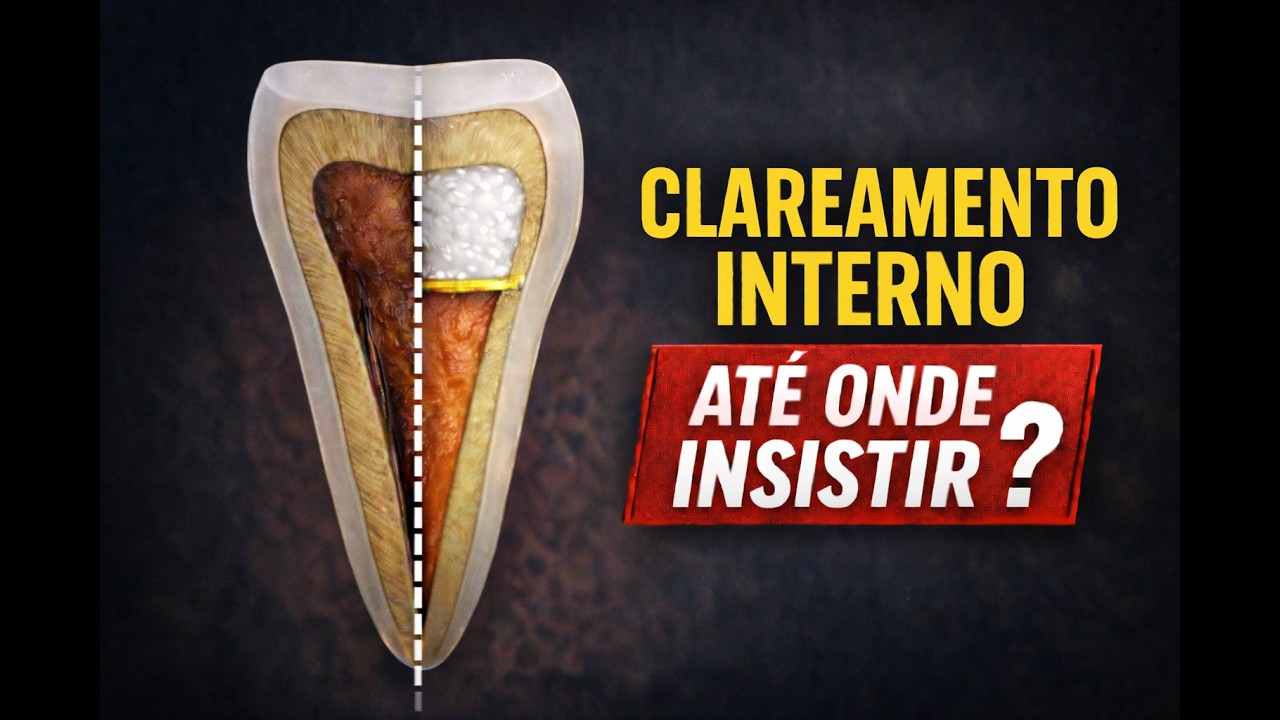 Dente escurecido: clareamento interno resolve? Quando indicar e quando NÃO fazer