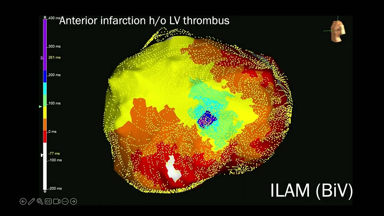 PR2024 - Ablation Of Ventricular Arrhythmias 2 - April 21, 2024