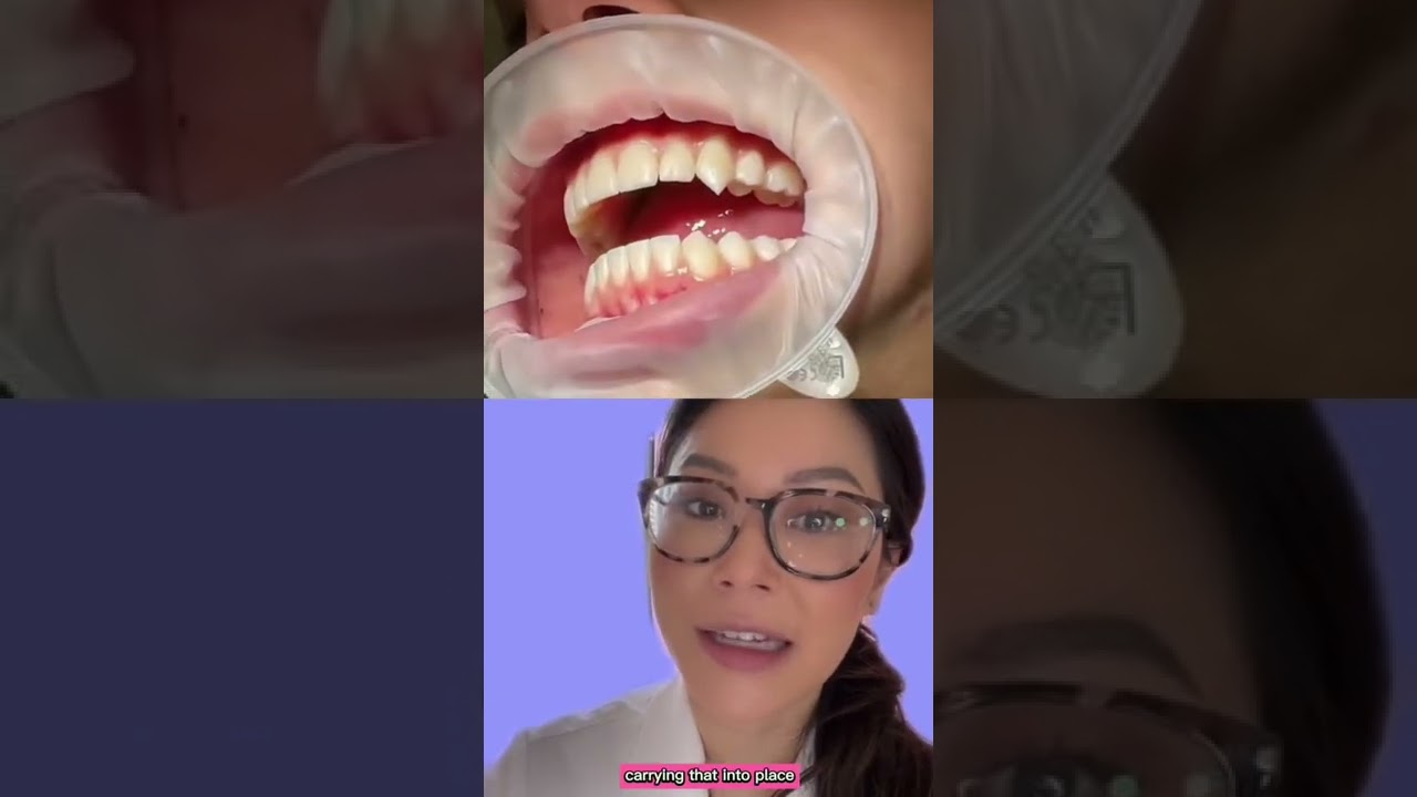 Get VAMPIRE FANGS at the dentist with composite bonding #vampire