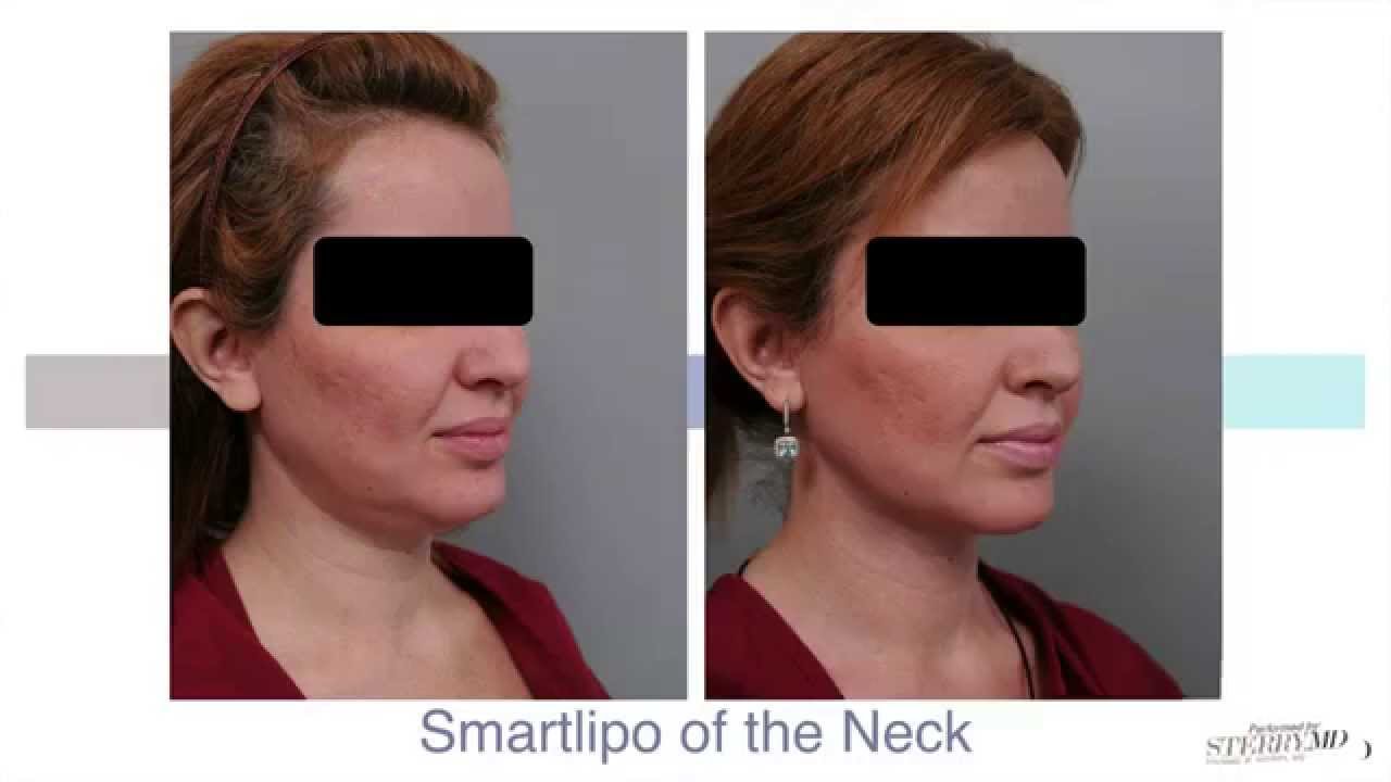 Double Chin Liposuction With Smartlipo&trade; | Dr. Sterry Explains