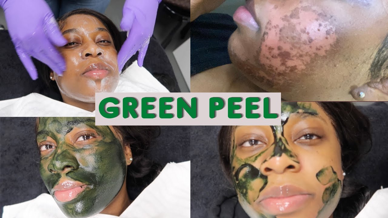 GREEN PEEL |  BEST FOR DAMAGED SKIN, HYPERPIGMENTATION & SCARS