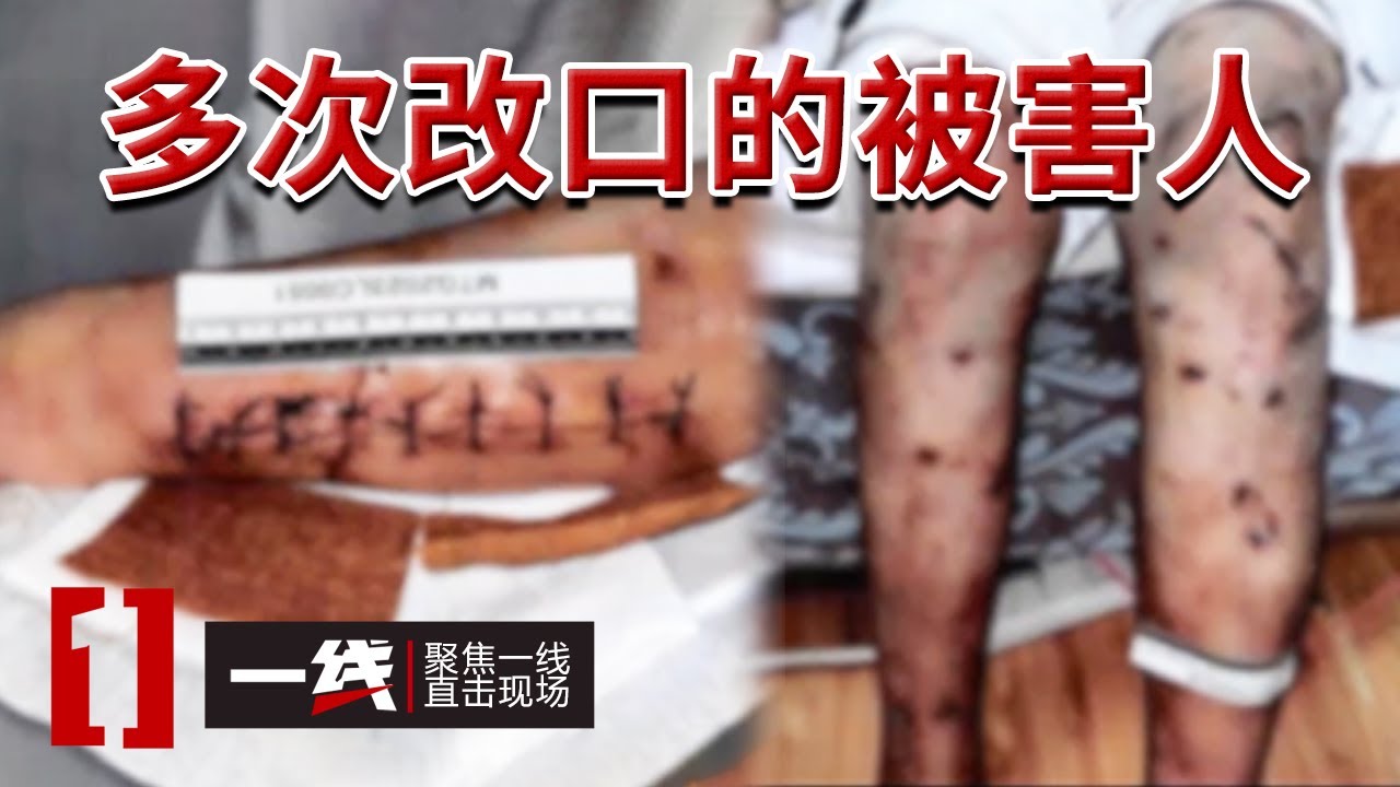 《一线》女子浑身伤痕报警称丈夫家暴 丈夫却说是妻子自残 真相究竟是什么？20241125