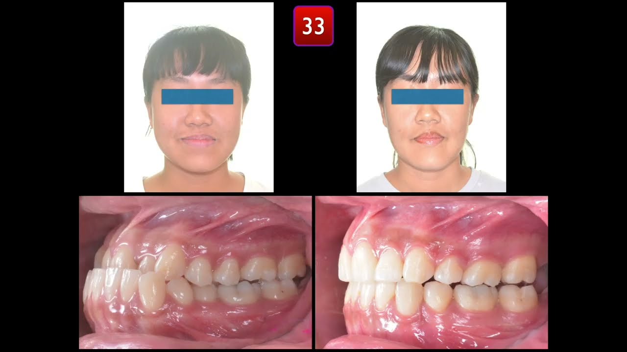 Solving Class III Malocclusion with Anterior Crossbite by Damon Q2｜【Chris Chang Ortho】CC763