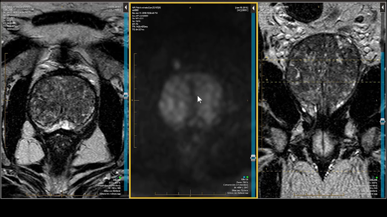 Prostate MRI — PI-RADS 2