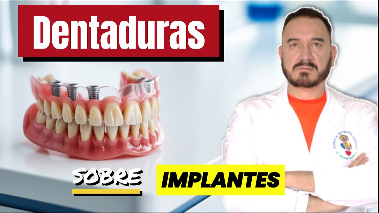 DENTADURAS Sobre IMPLANTES: Todo lo que tienes que saber!