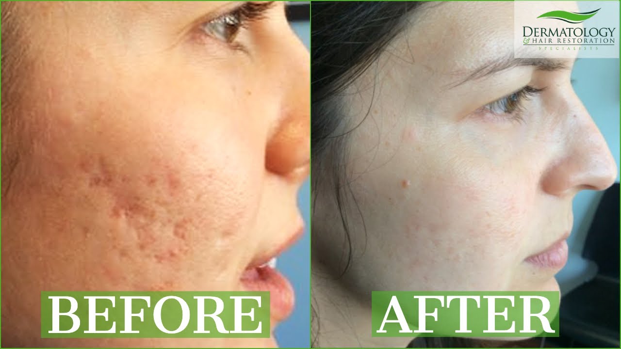ICE PICK SCAR Acne Results Testimonial - TCA CROSS - Dr. Ben Behnam - Los Angeles