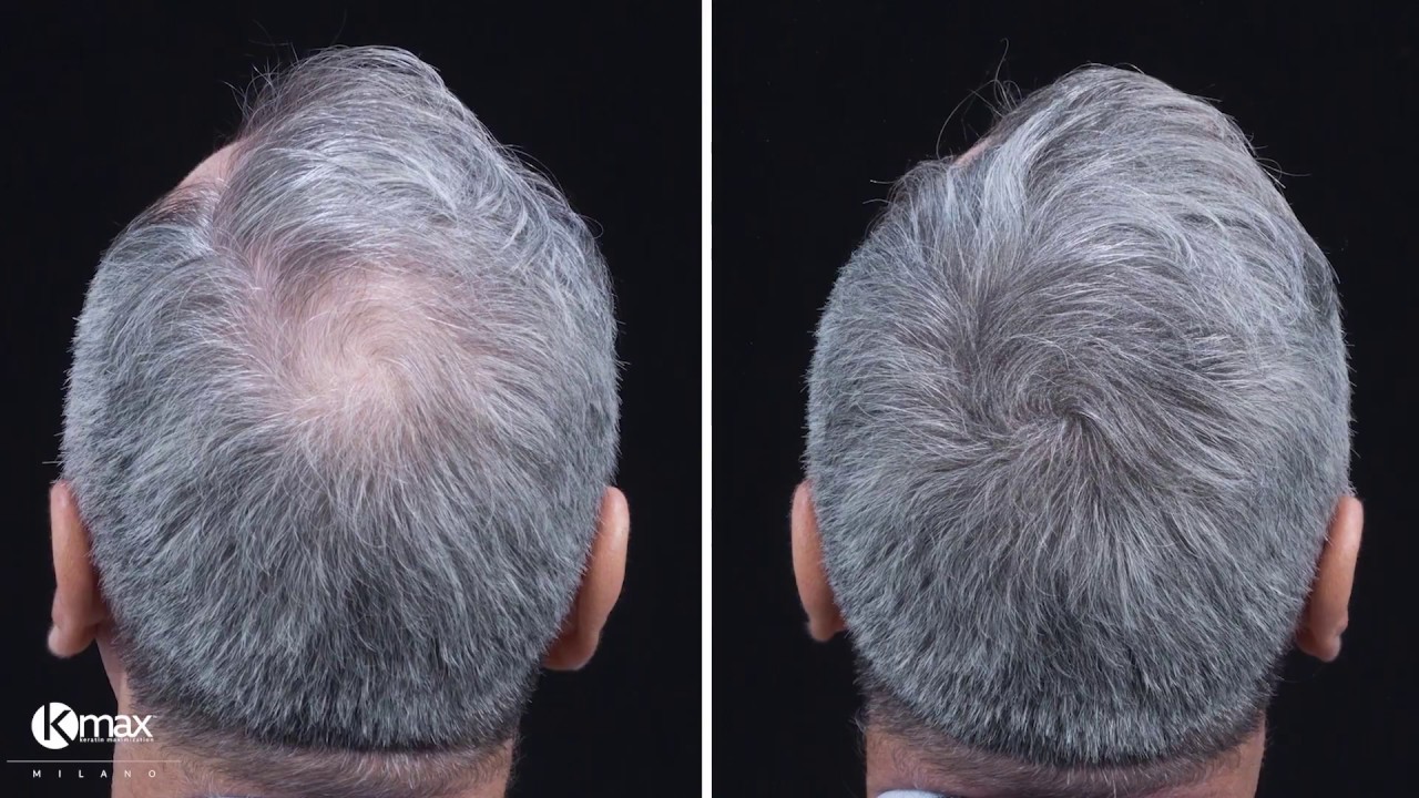 Kmax Tutorial - George shows us how to cover the crown with Kmax Hair Fibers and Fixing Spray