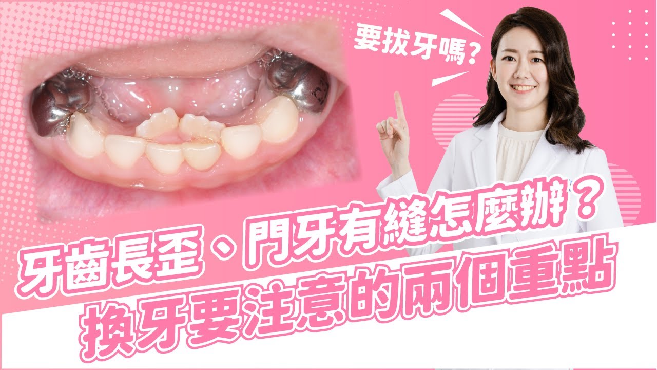 牙齒長歪、門牙有縫怎麼辦？換牙期要注意的重點