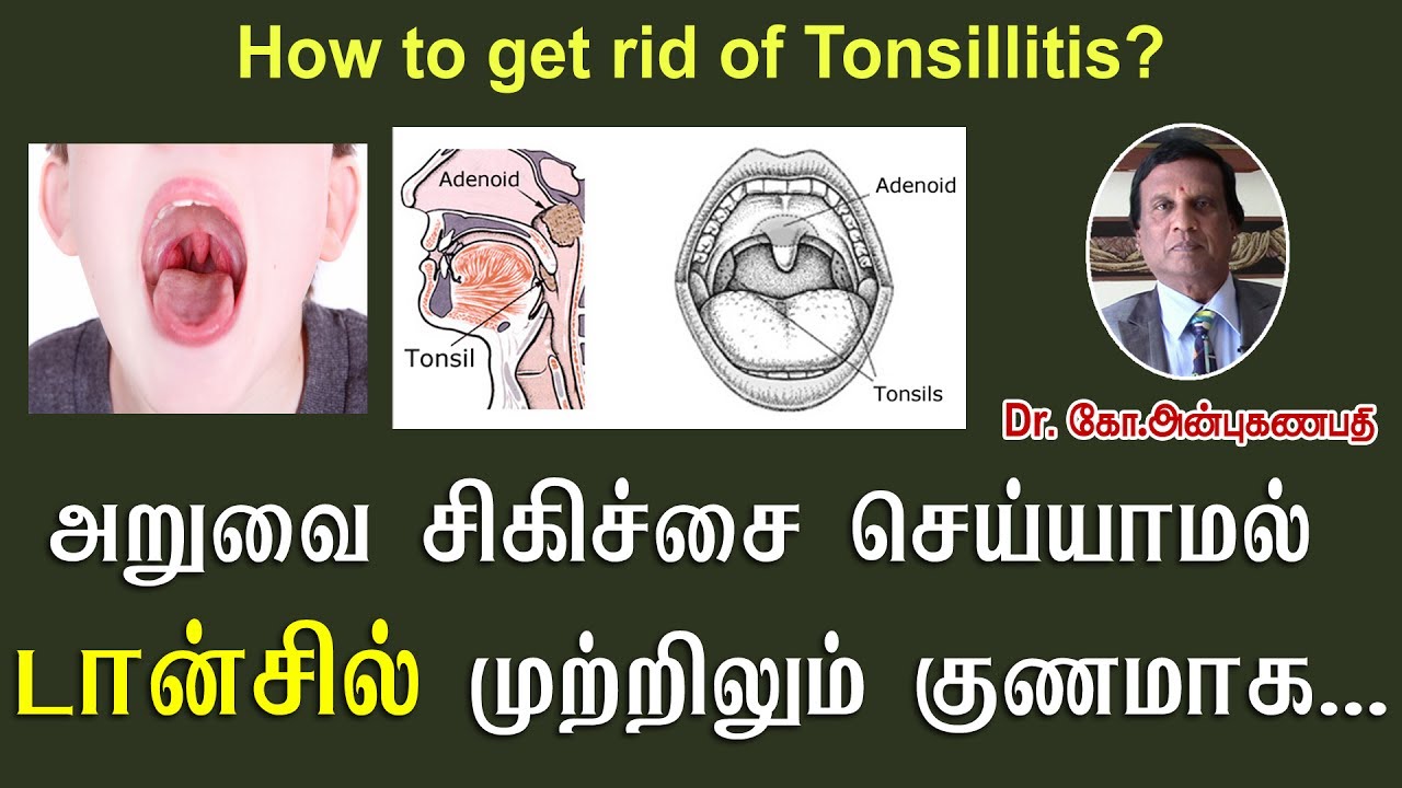 அறுவை சிகிச்சை செய்யாமல் டான்சில் முற்றிலும் குணமாக | Tonsillitis and Adenoids natural cure