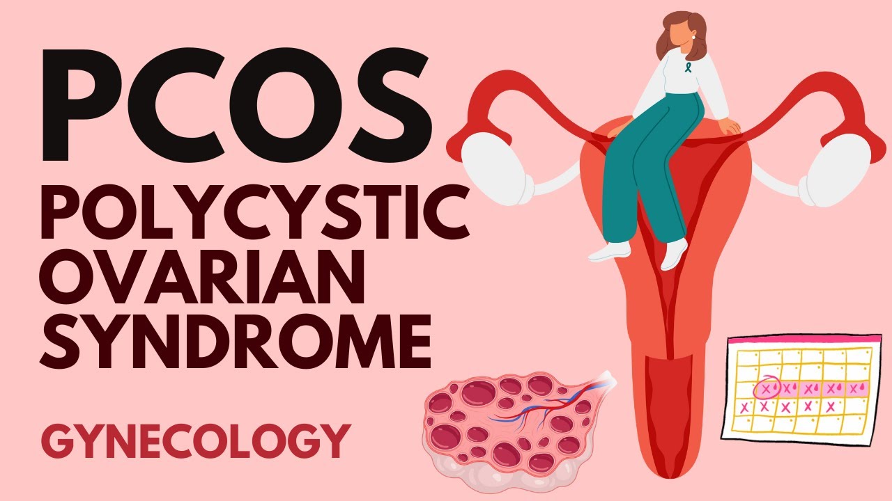 The Complete Guide to PCOS