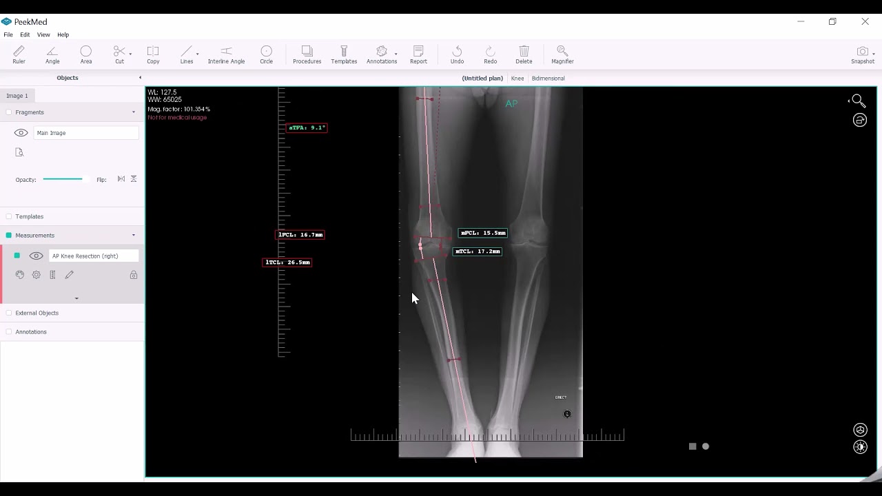 Knee Resection: Quickly choose the right template replacement
