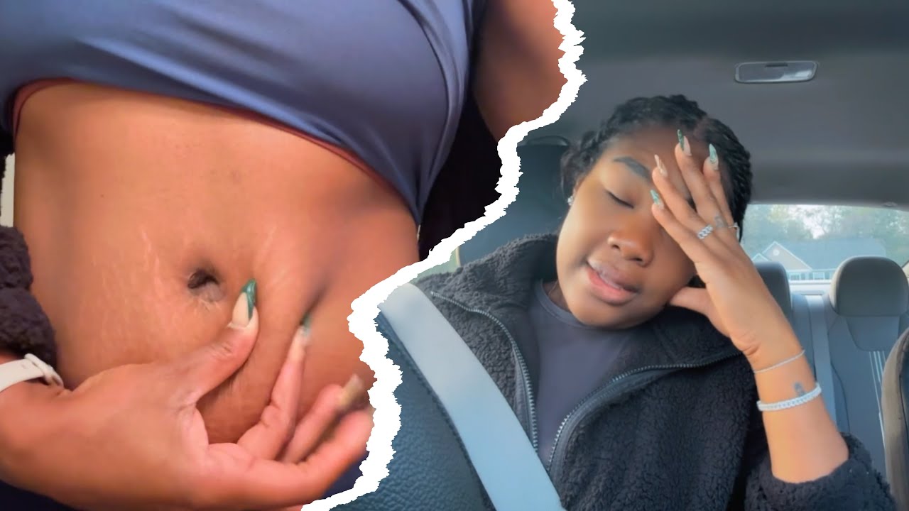 Tummy Tuck Recovery : 7 Month Update